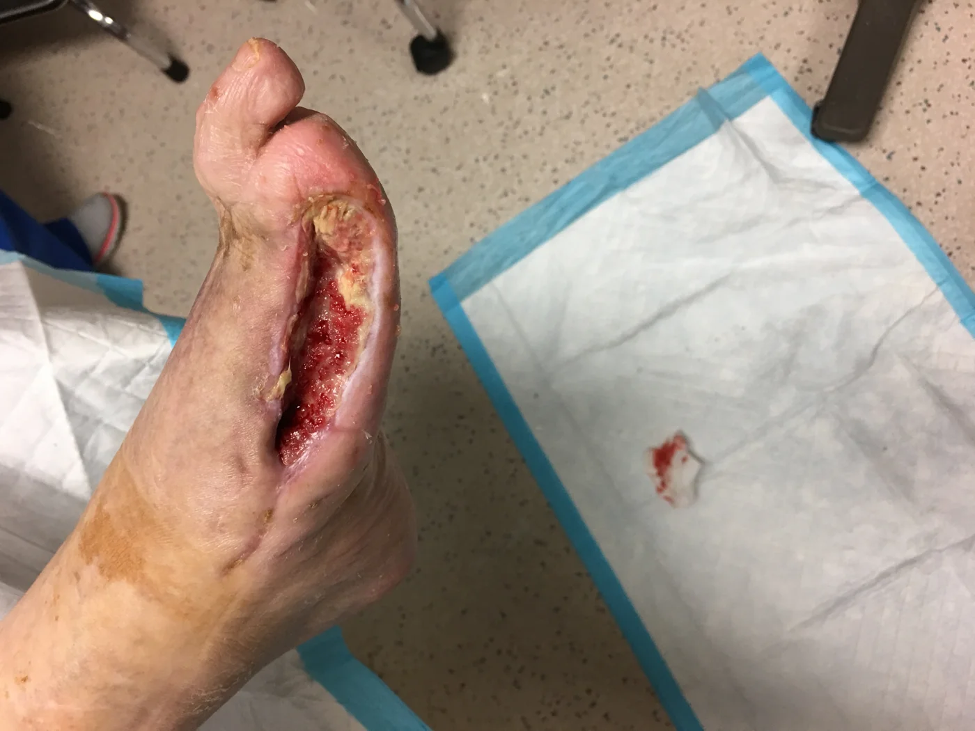 Surgical wound healing progression